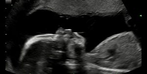 Ultrasound- Baby Erb